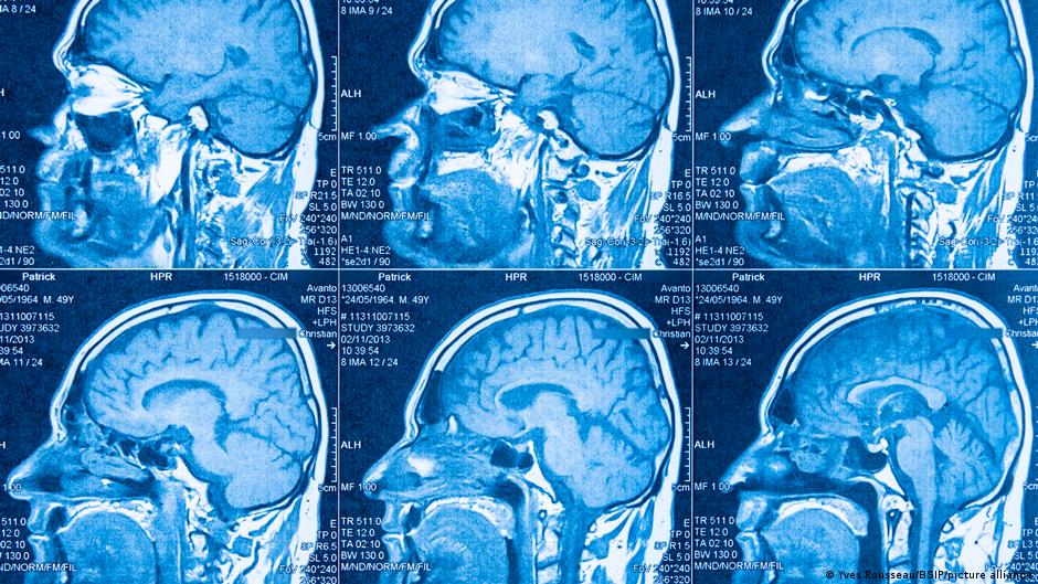 Descubren dos subtipos de autismo en el cerebro