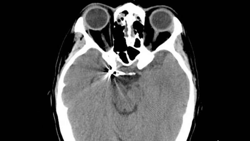 Reconoce las señales de alerta del aneurisma cerebral que todos deben saber